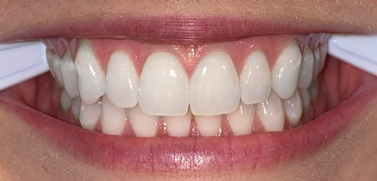 photo of teeth middile