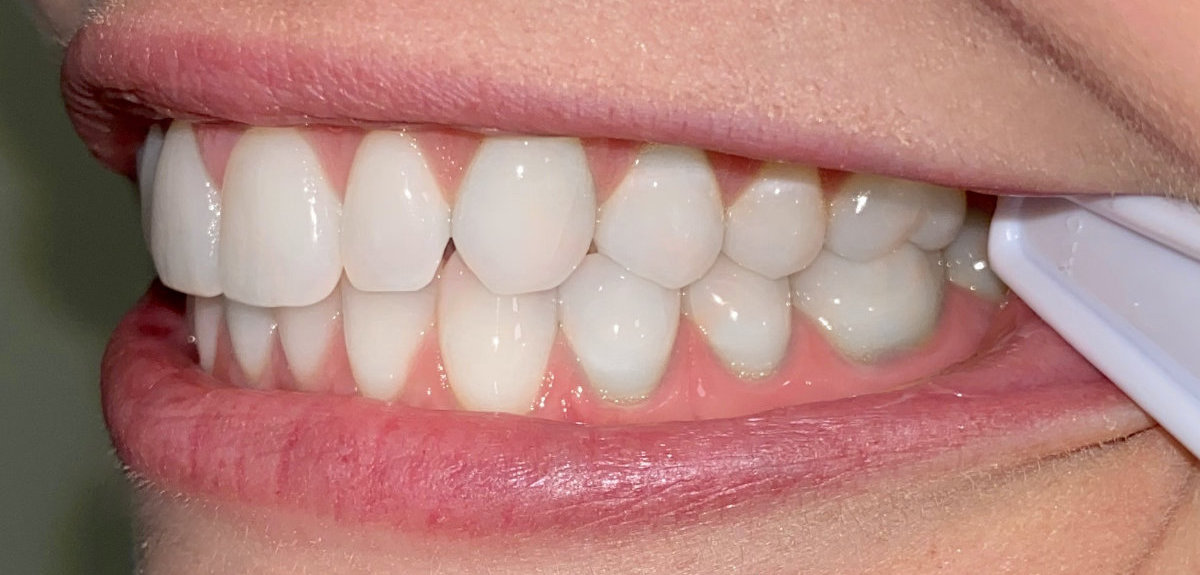 photo of teeth right