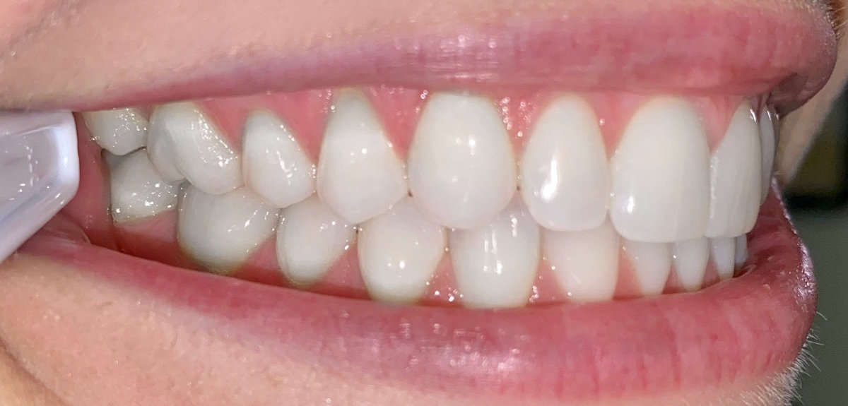 photo of teeth left