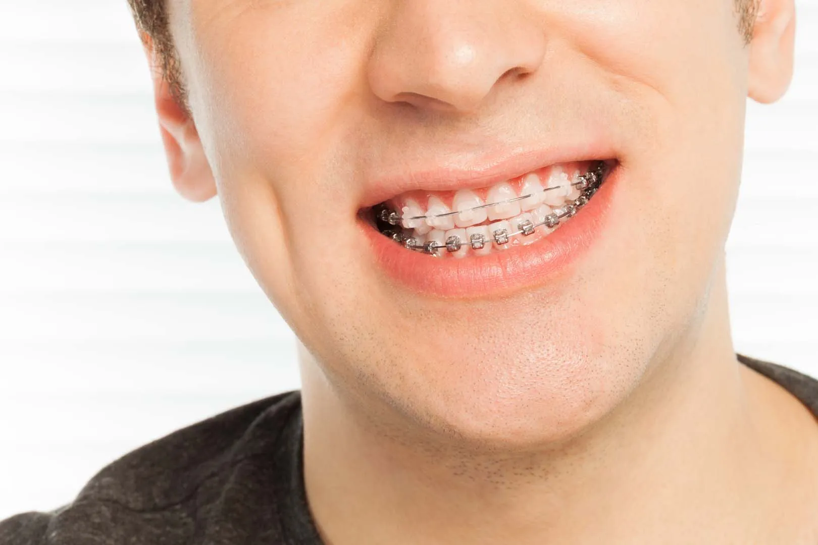clear braces near vista ca