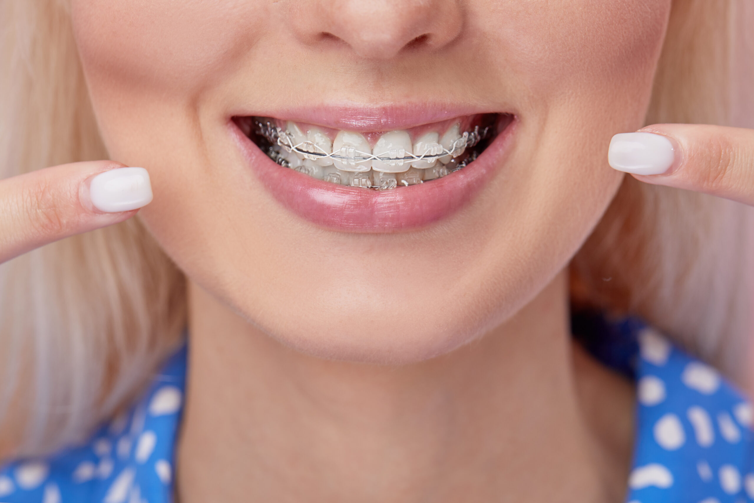 clear braces near vista ca