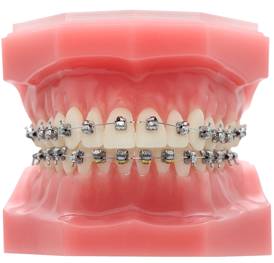 metal braces on model