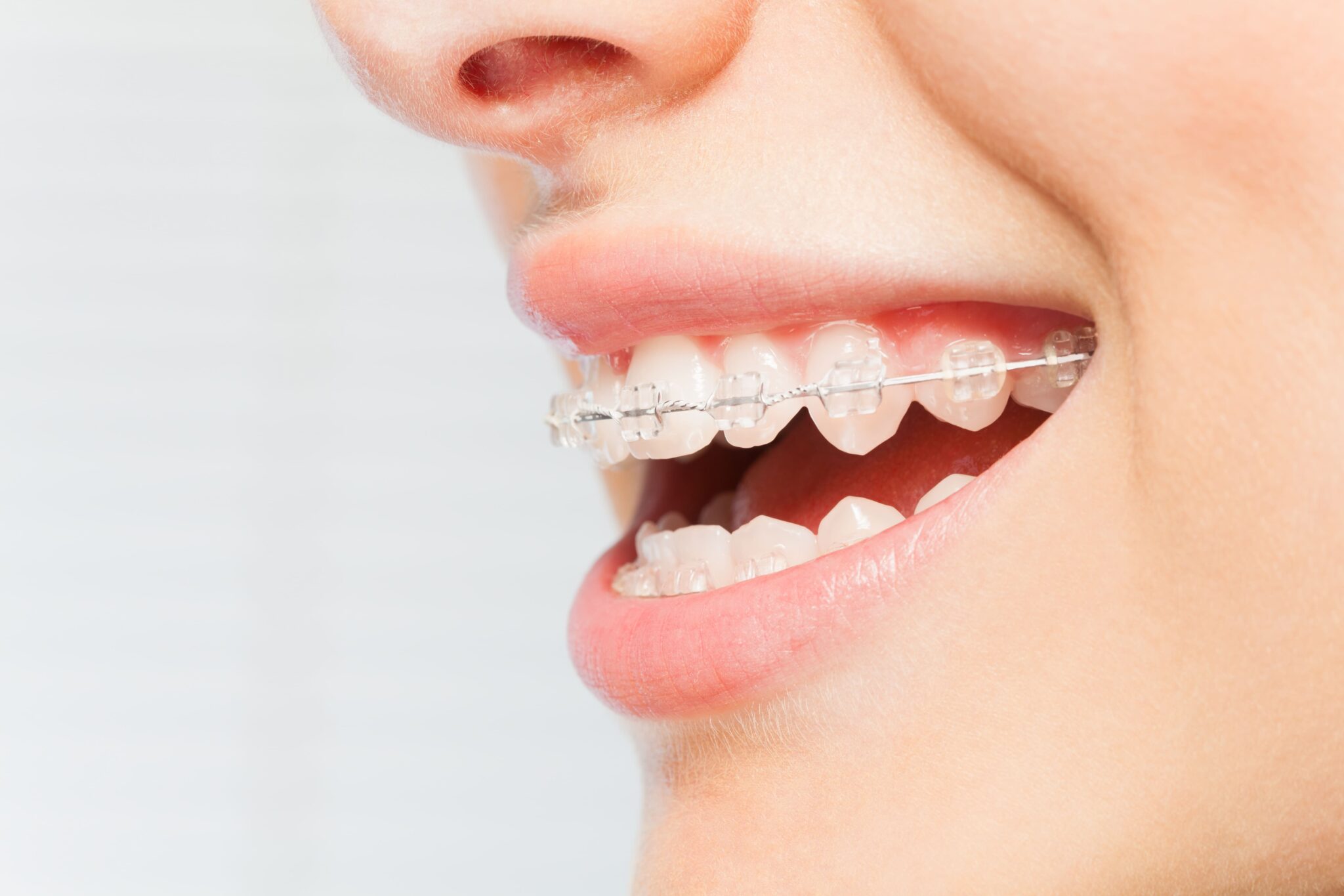 Choosing Between Traditional Braces and Clear Braces in Vista | The ...